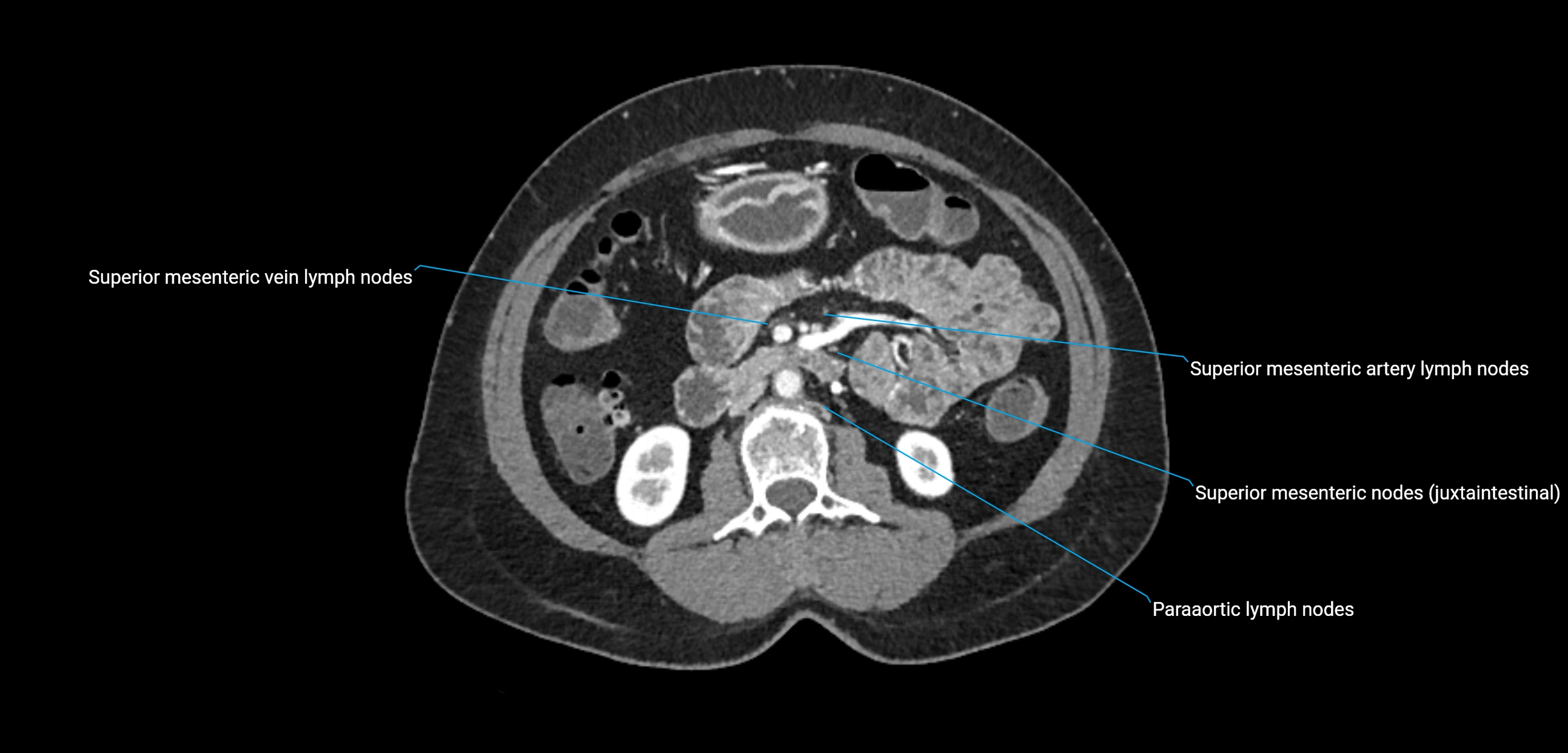 CT ct abdominal lymph nodes  axial cross sectional anatomy  enchanced radiology image -img-00002-00207.webp